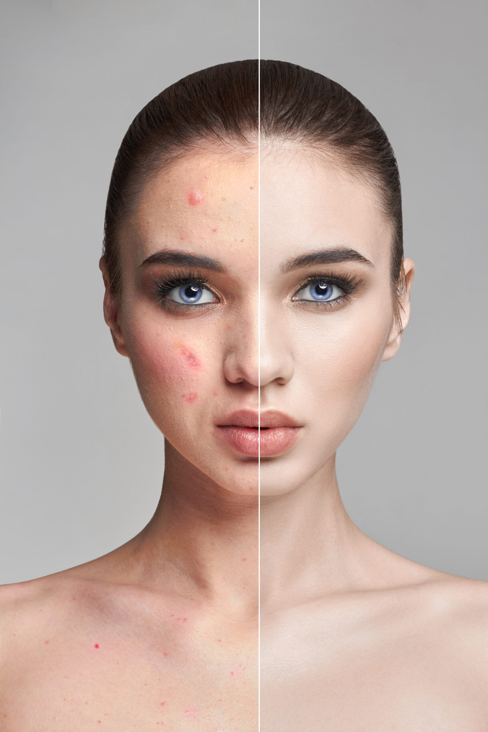 Acne Treatment | Aiconic Health