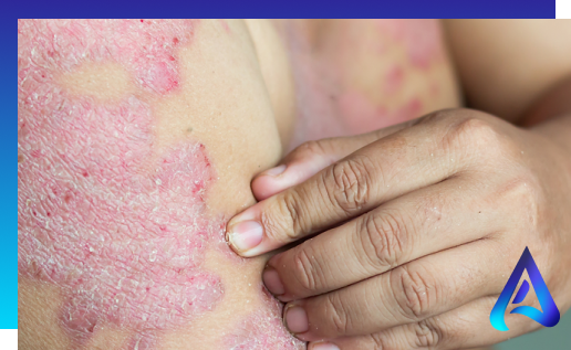 Eczema | Dermatitis